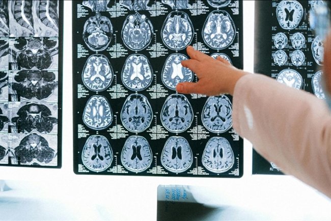 İnsan beyninde biriken plastik bileşen miktarında 8 yıl öncesine kıyasla yüzde 50 artış gözlendi