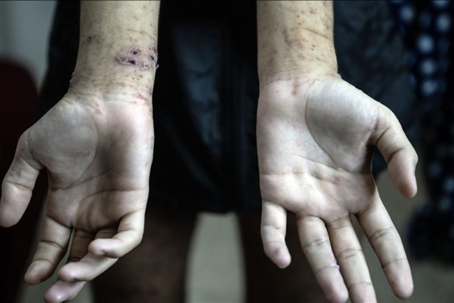 İşgalci hapishanelerindeki Gazzeli tutuklular, en korkunç koşullara maruz kalıyor