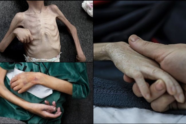 İşgalcilerin ablukası nedeniyle yetersiz beslenen Gazzeli çocukların üzerinde "ölüm" kol geziyor