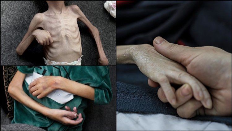 İşgalcilerin ablukası nedeniyle yetersiz beslenen Gazzeli çocukların üzerinde "ölüm" kol geziyor