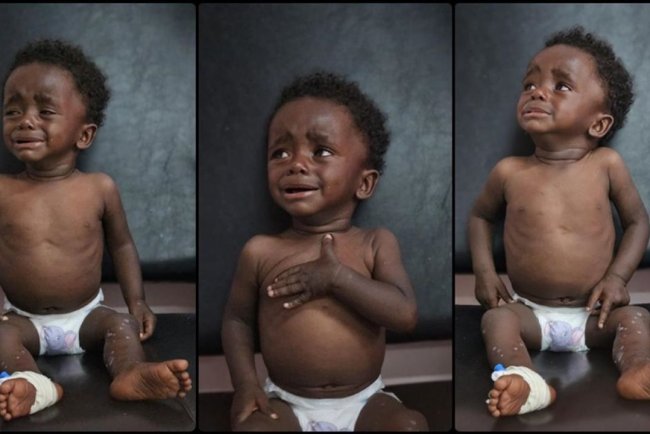 İşgalcilerin Gazze'deki ablukası, çocukları yetersiz beslenme ve hastalıkların pençesine itiyor