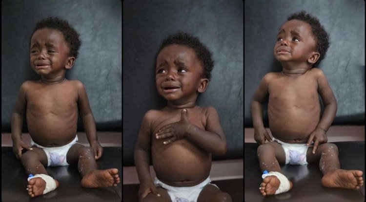 İşgalcilerin Gazze'deki ablukası, çocukları yetersiz beslenme ve hastalıkların pençesine itiyor