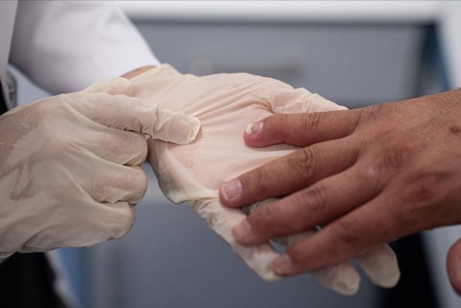 Sedef romatizmasında erken tanı eklem hasarını önlüyor