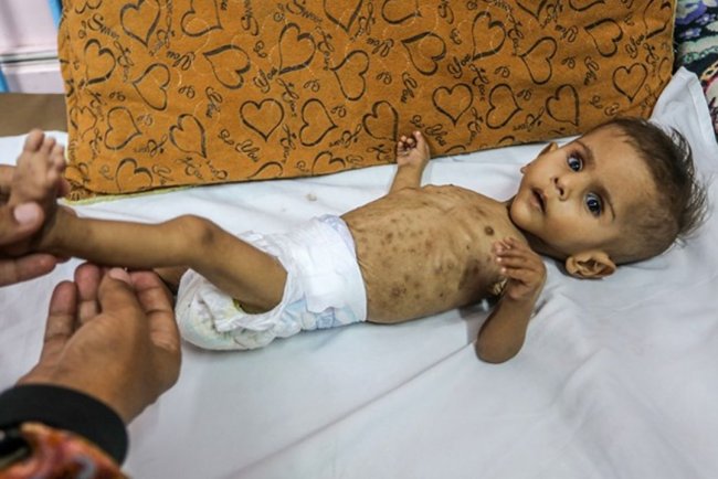 İşgalcilerin kıtlığı dayattığı Gazze'de son 24 saatte 2'si çocuk 6 kişi daha açlıktan şehit oldu